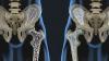 Zakaj kalcij ne bi bilo treba sprejeti za osteoporozo? Celotna resnica o kalcija, in kako ohraniti kostno tkivo v dobri formi