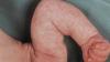 "Marmorna" koža pri dojenčkih: norma ali patologija? Odgovori nevrolog