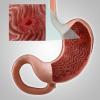 Gastritis, ali erozije želodca: glavni simptomi, zdravljenje, prehrana