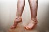 Kršitve pretoka krvi v nogah: Vzroki, simptomi