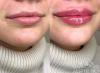 Izgleda, da so ustnice po povečanju popravek navpično asimetrije