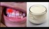 Kako preprečiti zobno gnilobo in krepijo imunski sistem