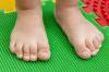 "Dobre" in "zle" oblike ploskih stopal pri otrocih