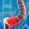 Rak debelega črevesa: 5 znakov, da bo pomagal, da ga ne zamenjujejo s hemoroidi