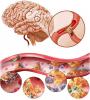 Možganska ateroskleroza: kako ravnati, kakšni so simptomi?