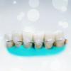 Priljubljene opornice zobe: koliko je učinkovito?
