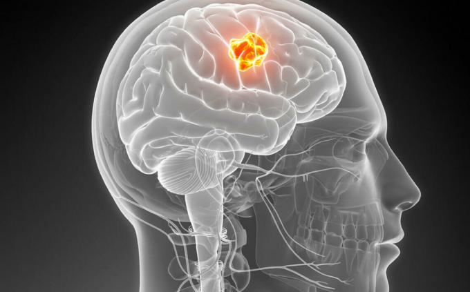 možganski tumor
