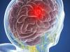 Možganski tumor: 5 simptomi, ki jih ni mogoče prezreti