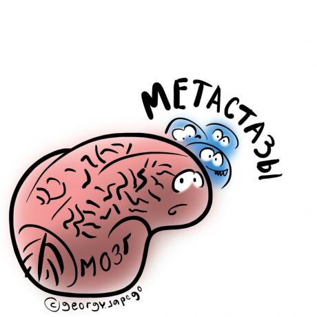 Brain metastaze