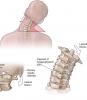 4 osnovne vaje za vratne hrbtenice bodo pomagali pozabiti na bolečino in osteohondroze!