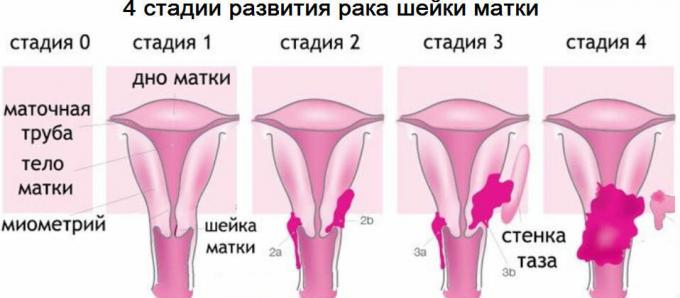 4 faze raka materničnega vratu