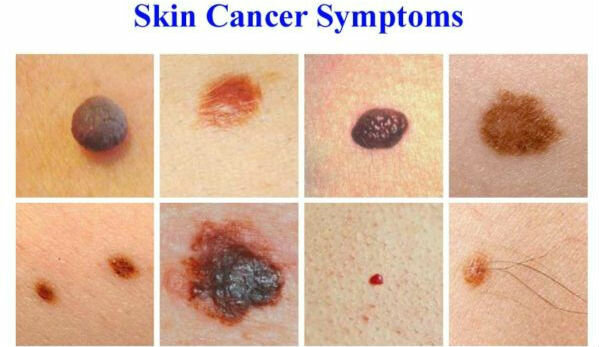 Simptomi raka kože