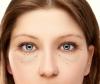 Kako se znebiti brez operacije, za kilo in spodnjo veko očesa vreče
