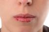 5 nasvetov, kako preprečiti pokanje ustnic